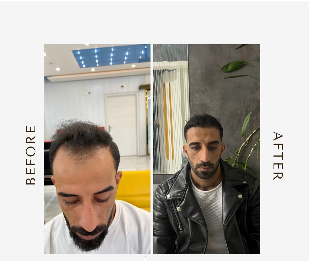 کاشت مو و ریش و ابرو مزوتراپیprp جناب