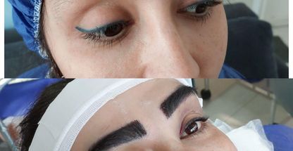 کاشت طبیعی  مو و ابرو