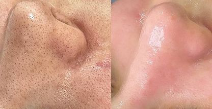 فیشیال وپاکسازی درمان جوش اسکار درمان لک