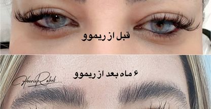 میکروبلیدینگ و میکروپیگمنتیشن حوریه راهب