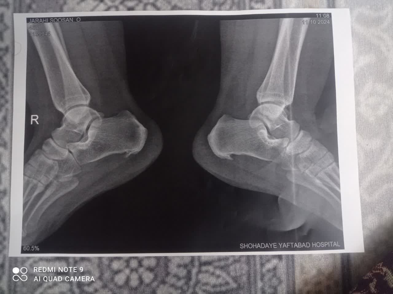 شکسته بندی استاد شهرزاد حکیم