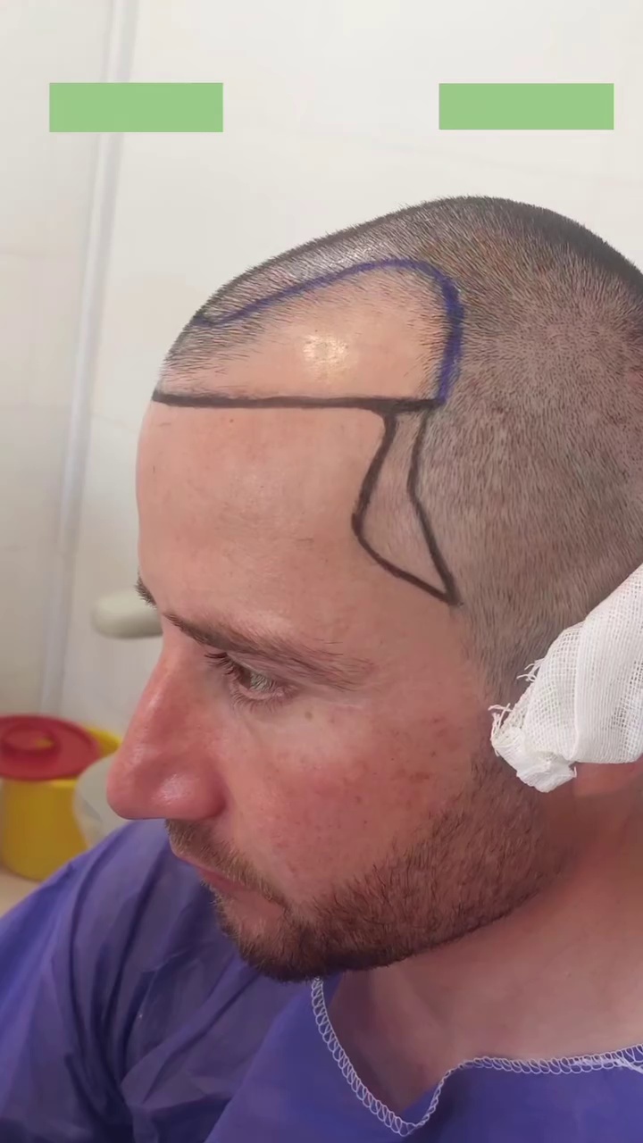 کاشت تخصصی موی طبیعی شهلا