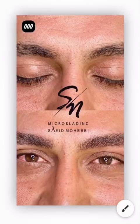 میکروبلیدینگ ابرو و میکرواسکالپ سر آقایان