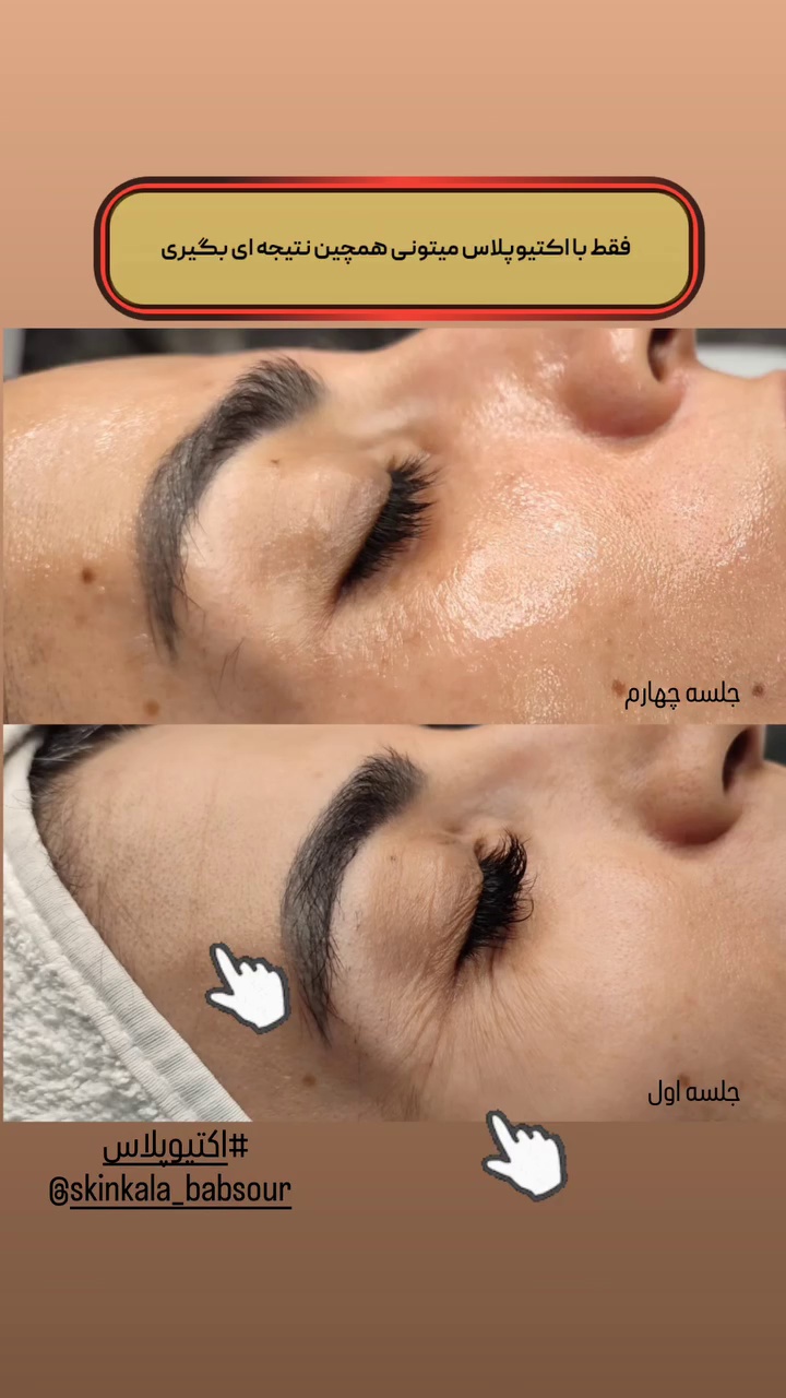 پاکسازی و درمان پوست ناهیدخانی