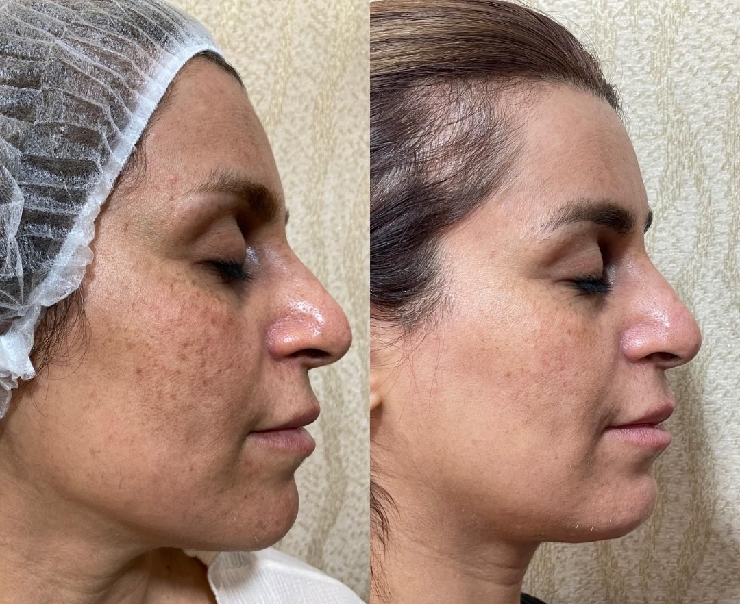 فیشال و پاکسازی. هایفو.پلاسماتراپی زهره