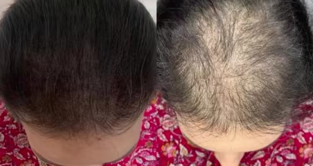 اسکالپ و میکرو اسکالپ سر خانم و آقا شادی