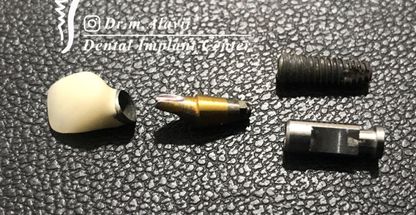 مرکز ایمپلنت دکتر علوی