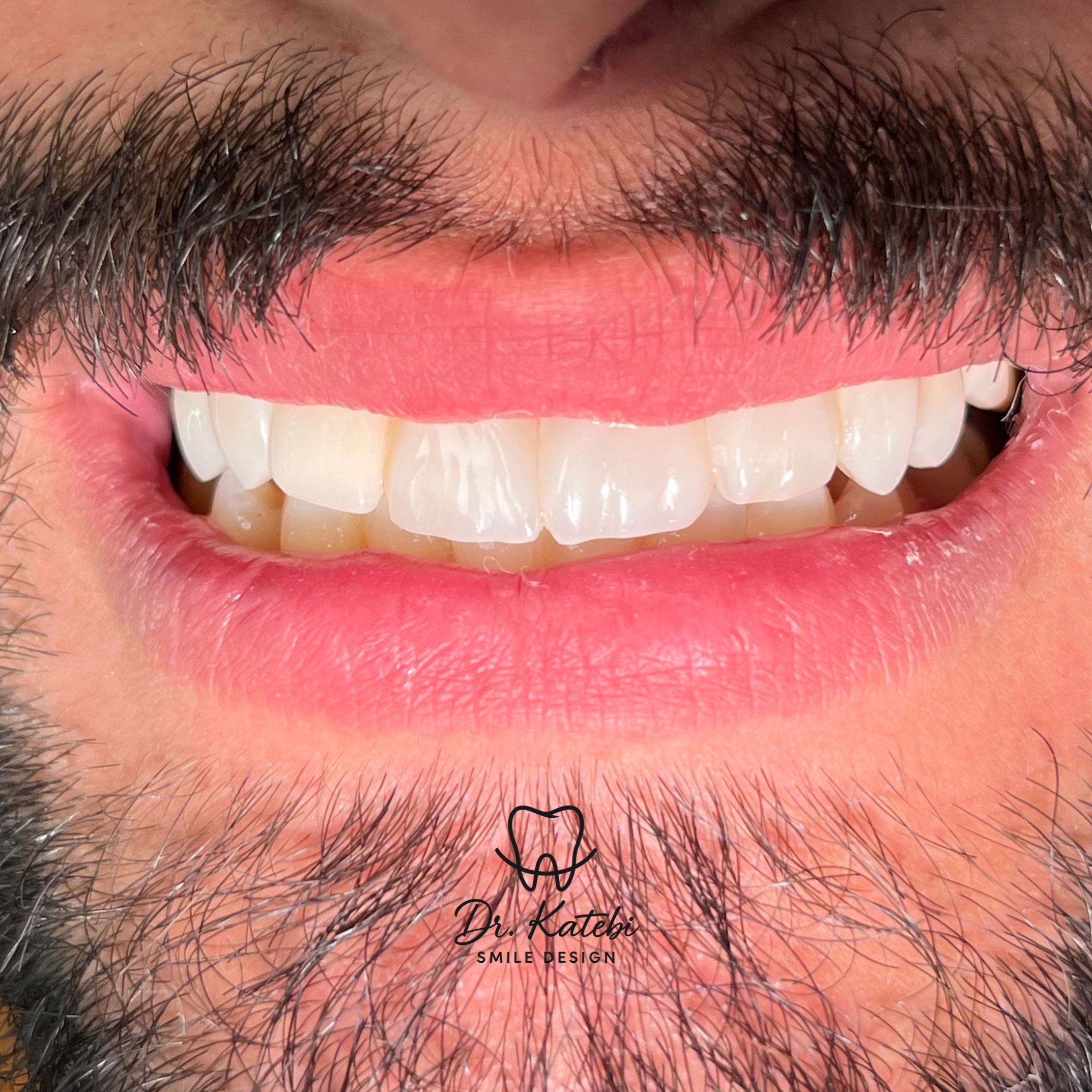 دندانپزشکی دکتر کاتبی کامپوزیت لمینیت