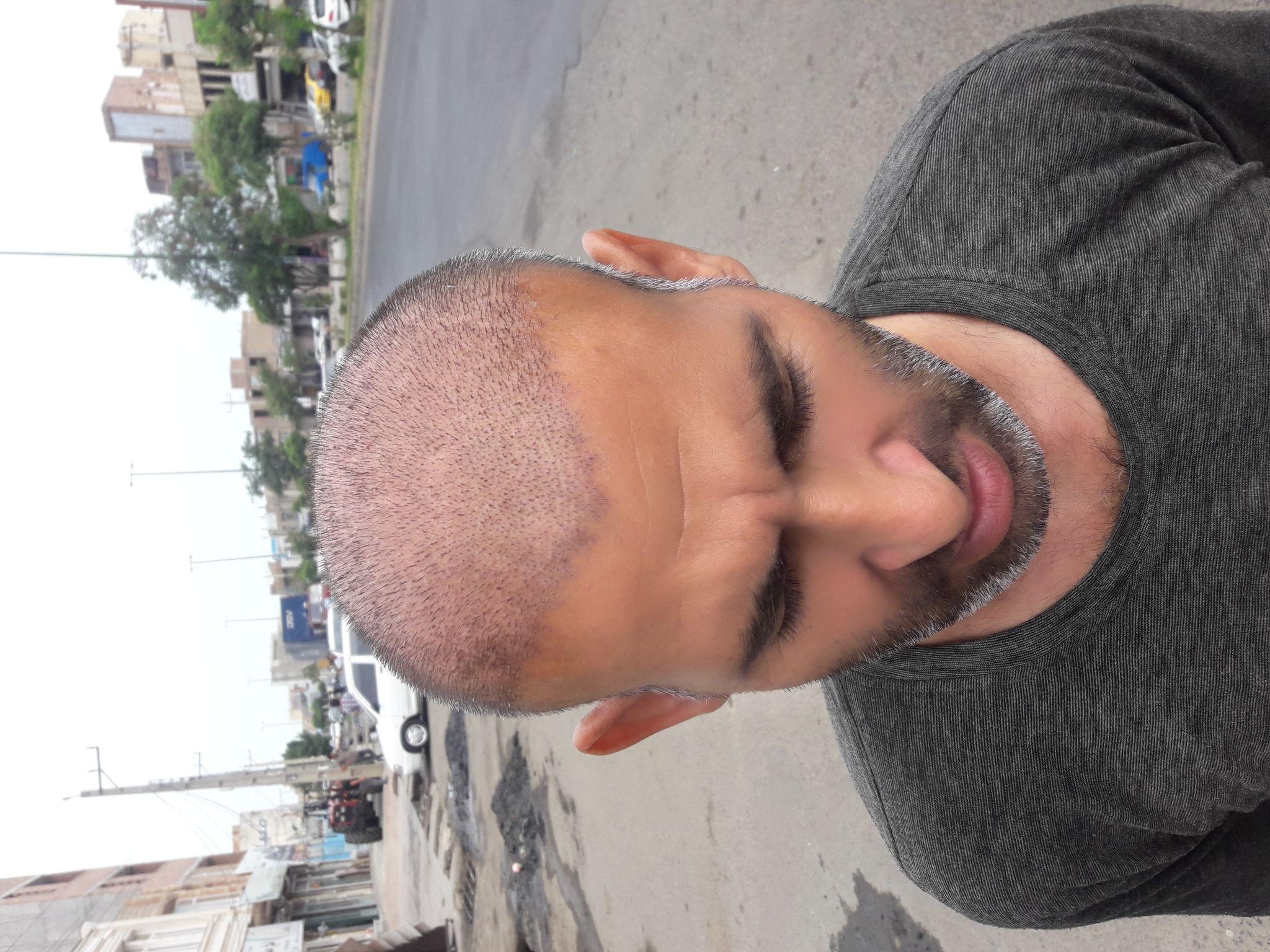 کاشت مو پارساباد