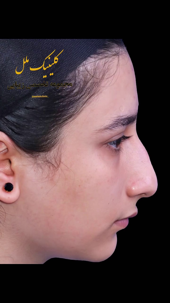 عمل بینی ملل کلینیک