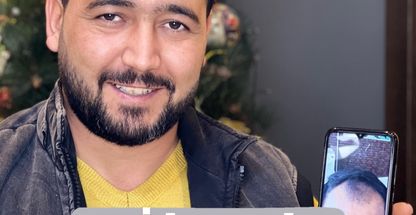 کلینیک کاشت مو و ابرو الماس در تبریز