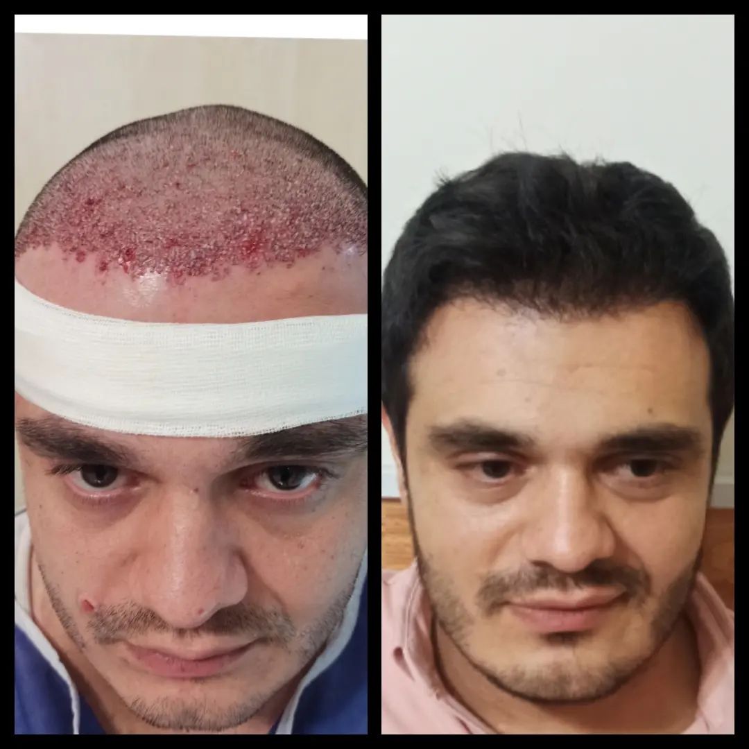 کلینیک کاشت مو سهند در تبریز