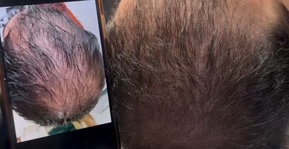 کلینیک تخصصی درمان ریزش مو مینا سعادت