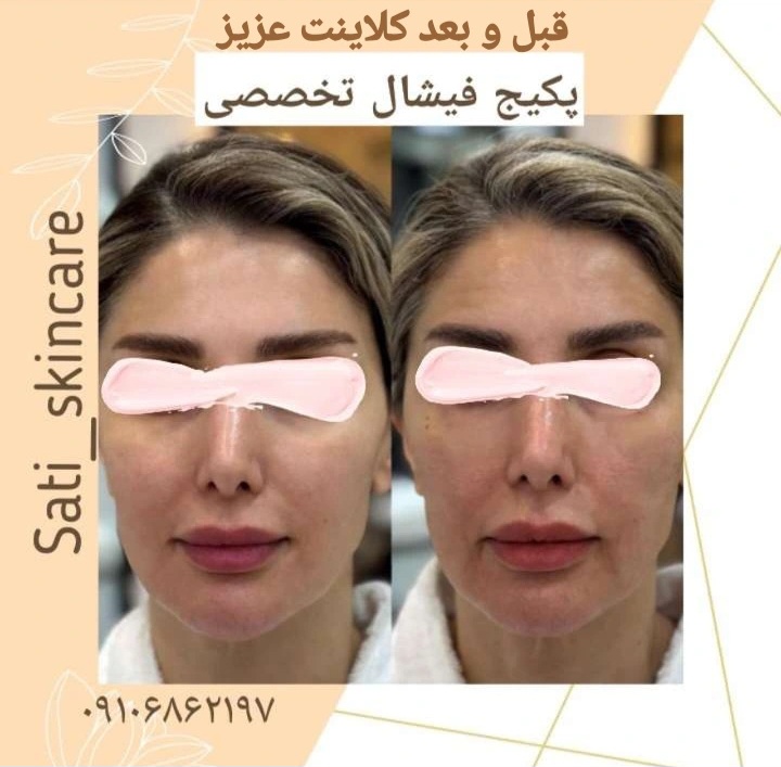فیشال و پاکسازی تخصصی ساتی