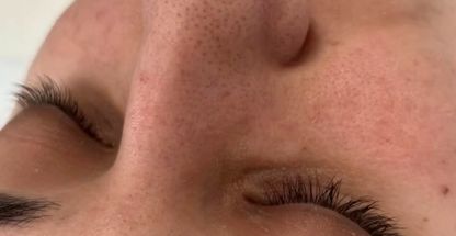 فیشال و پاکسازی پوست تخصصی بانوان نیلا