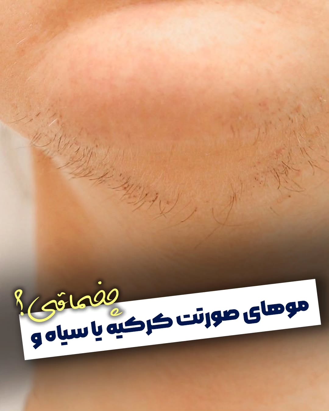 لیزر خورشید