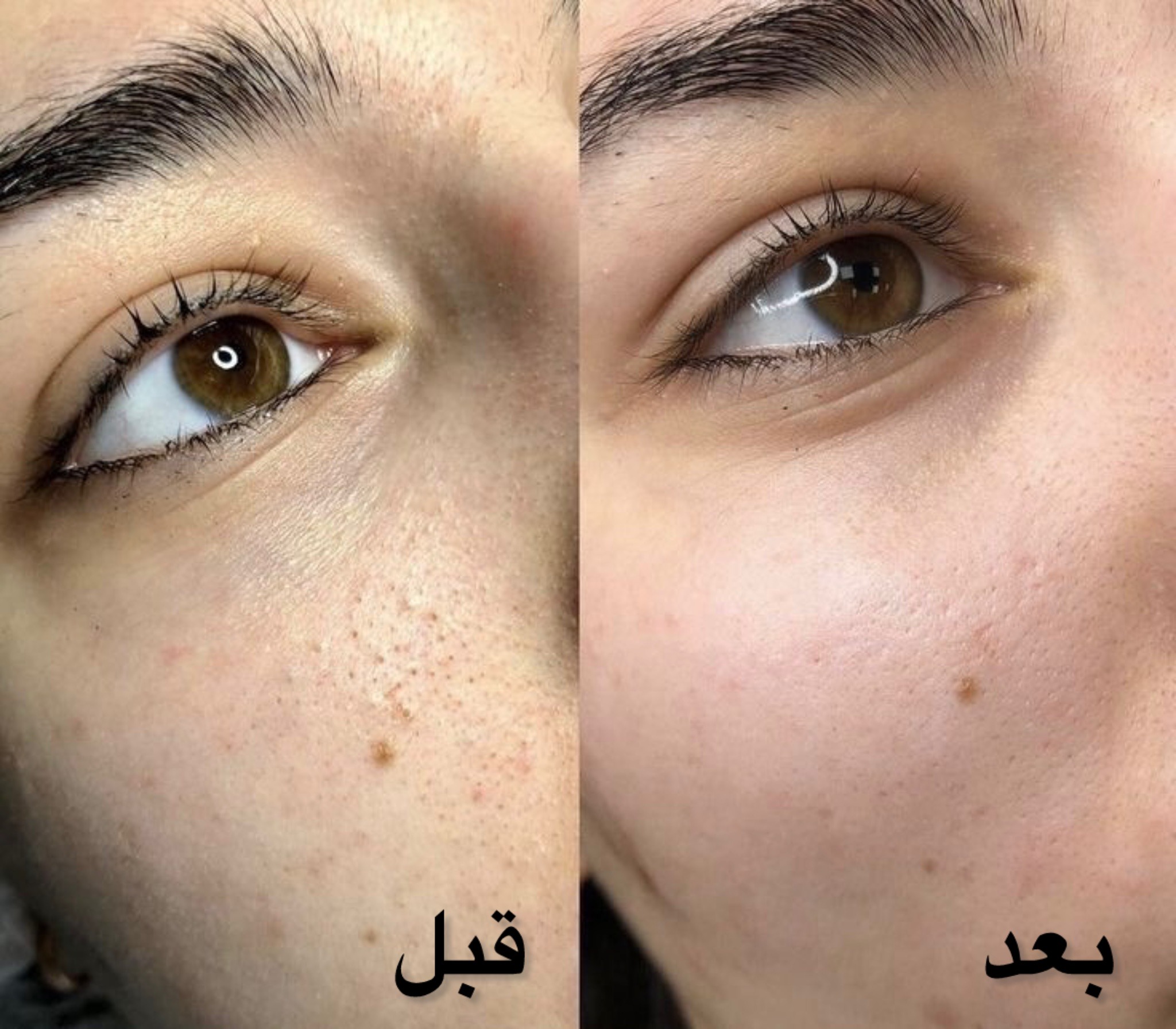 پاکسازی، فیشیال و جوانسازی نسترن