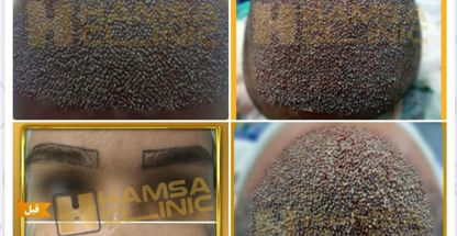 کلینیک تخصصی کاشت مو ابرو همسا