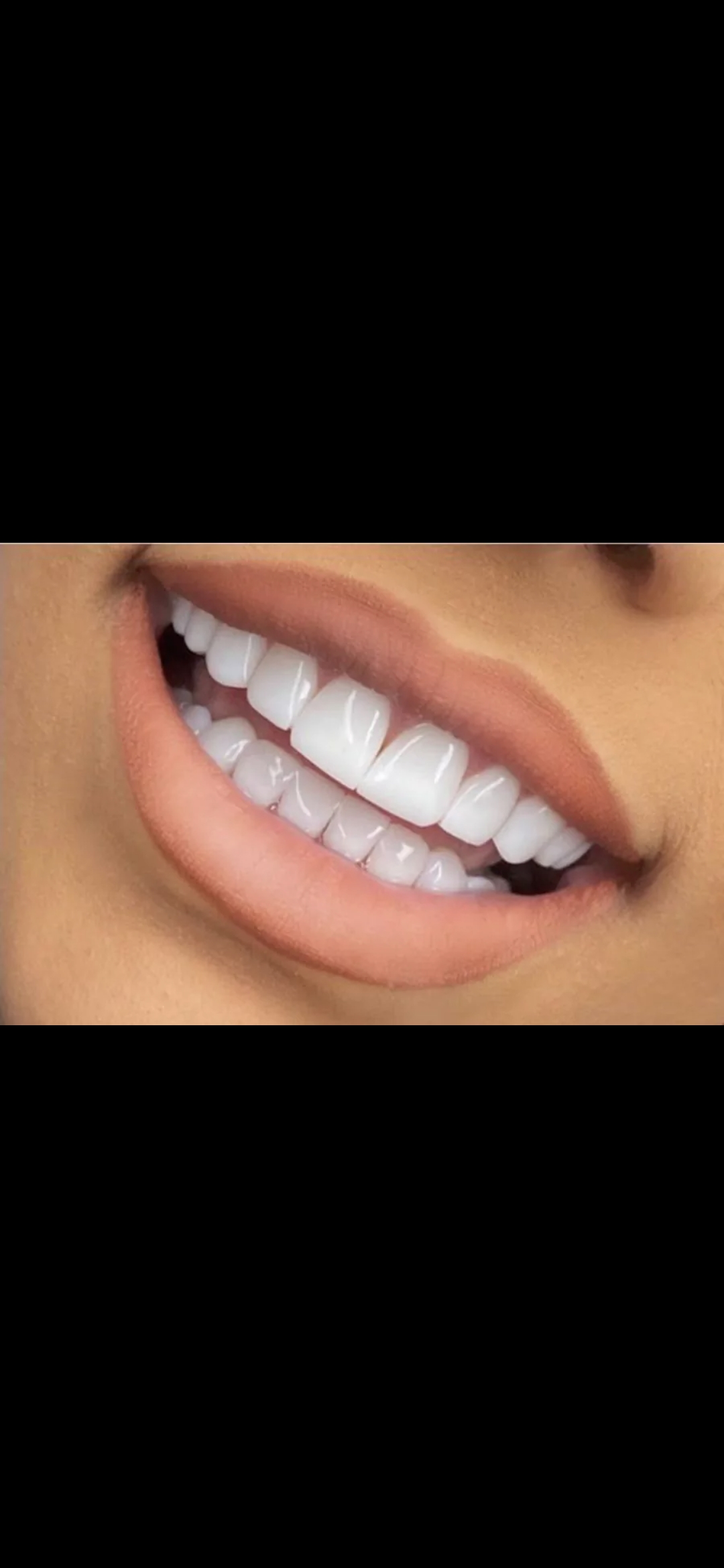 کامپوزیت زیبایی دندان  فرزین