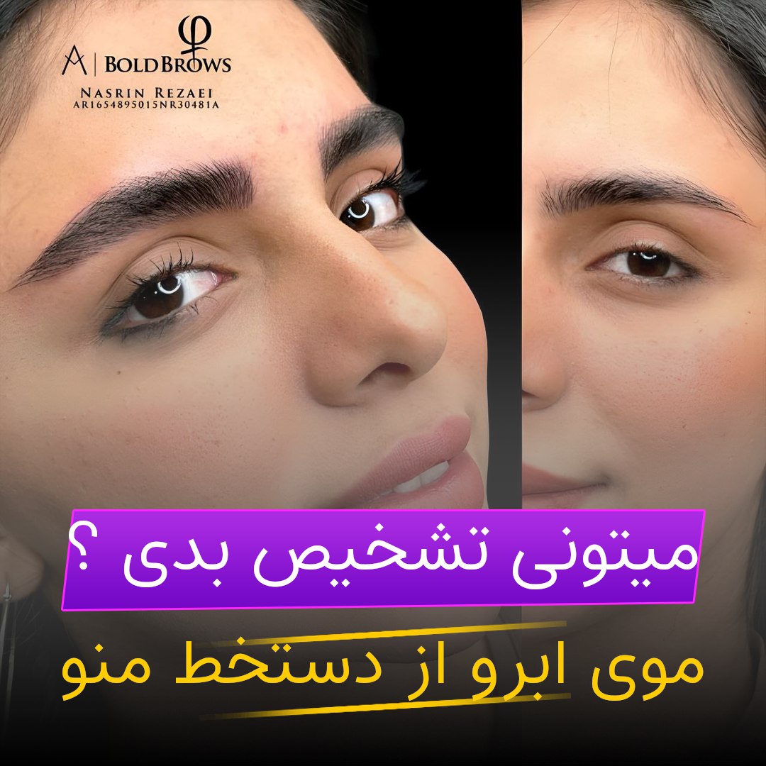 میکروبلیدینگ،فیبروز نسرین رضایی