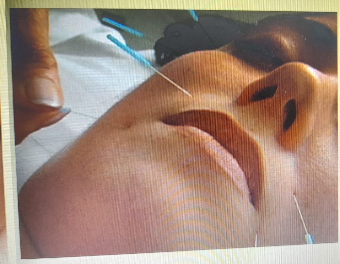 طب سوزنی و ماساژ دراوی پور