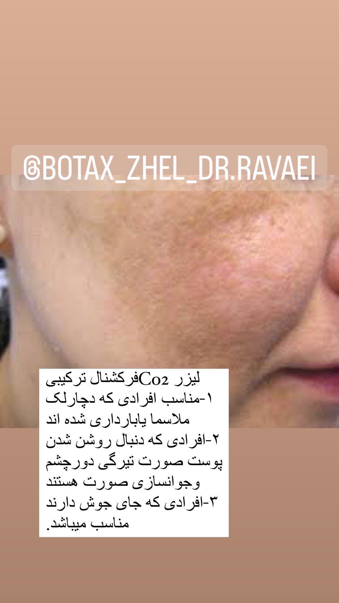 لیزر co2ترکیبی ضدلک وجوانساز کلینیک رایدو