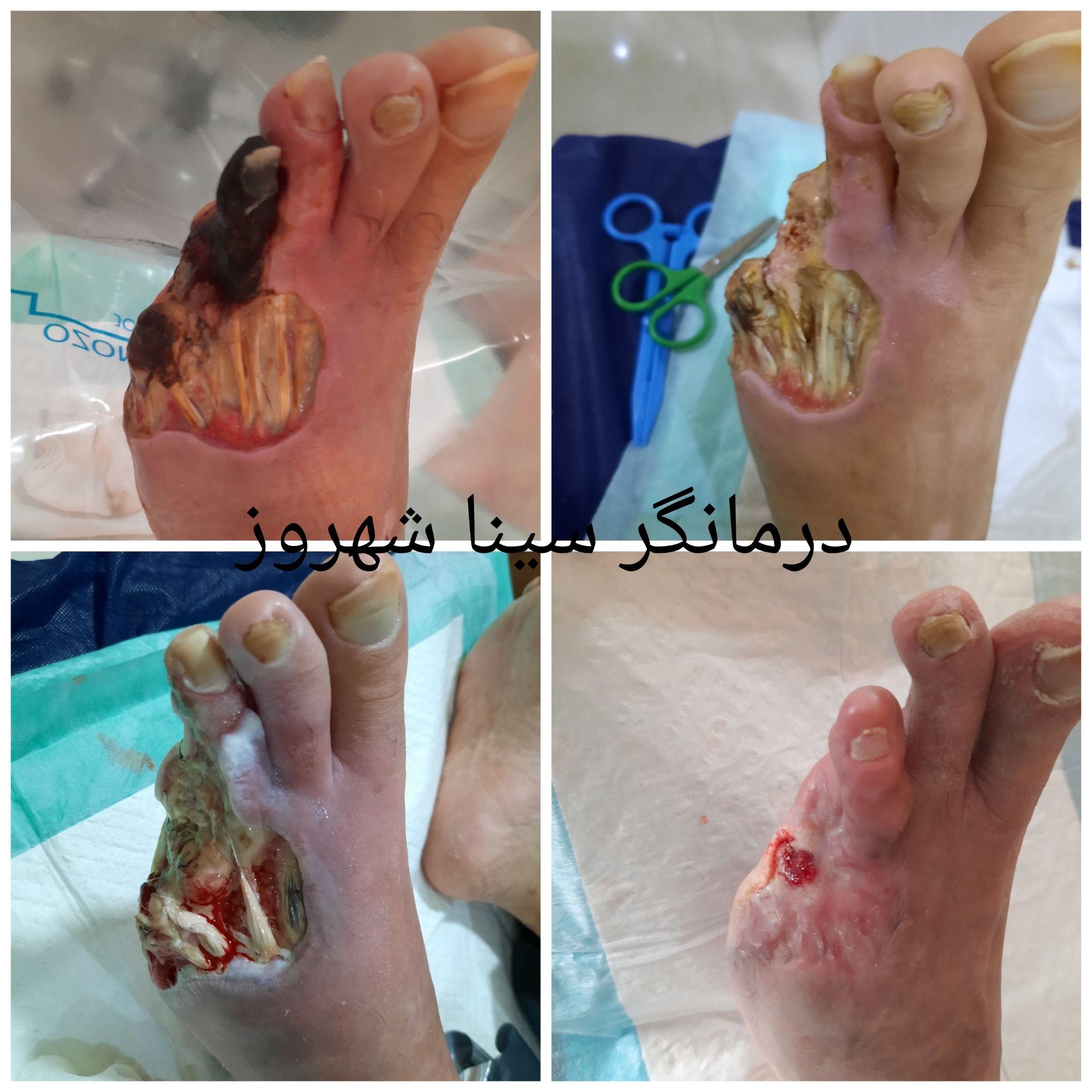 کلینیک درمان زخم و دیابت کرج مهرشهر