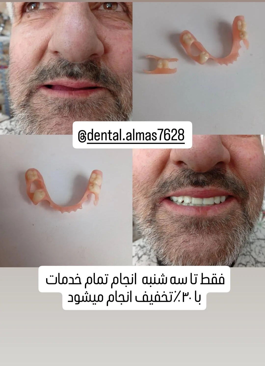 کامپوزیت لایرینگ و دندانسازی دکتر صفری