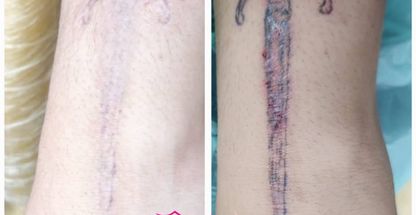 لیزر الکساندرایت و کلینیک زیبایی نیکان