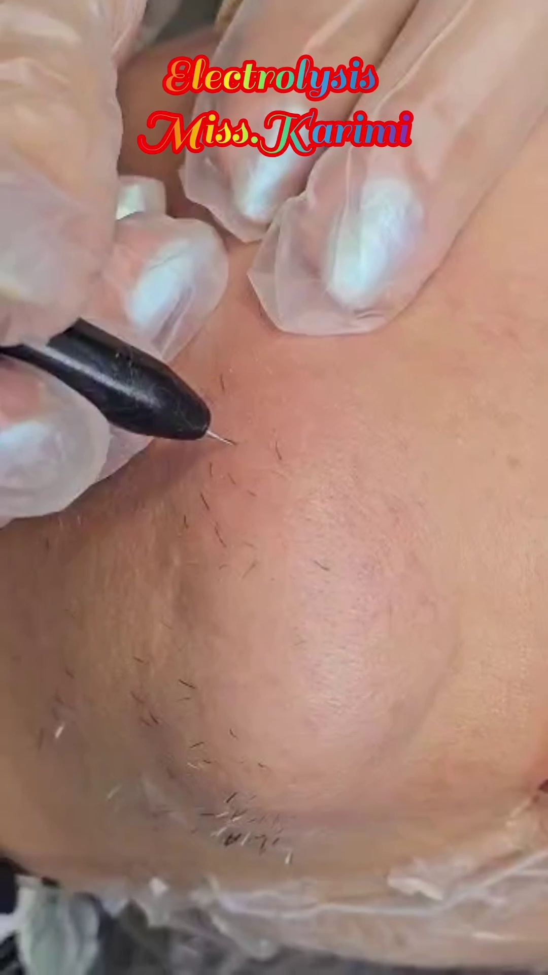 الکترولیز کریمی( رفع موی زائد سفید)