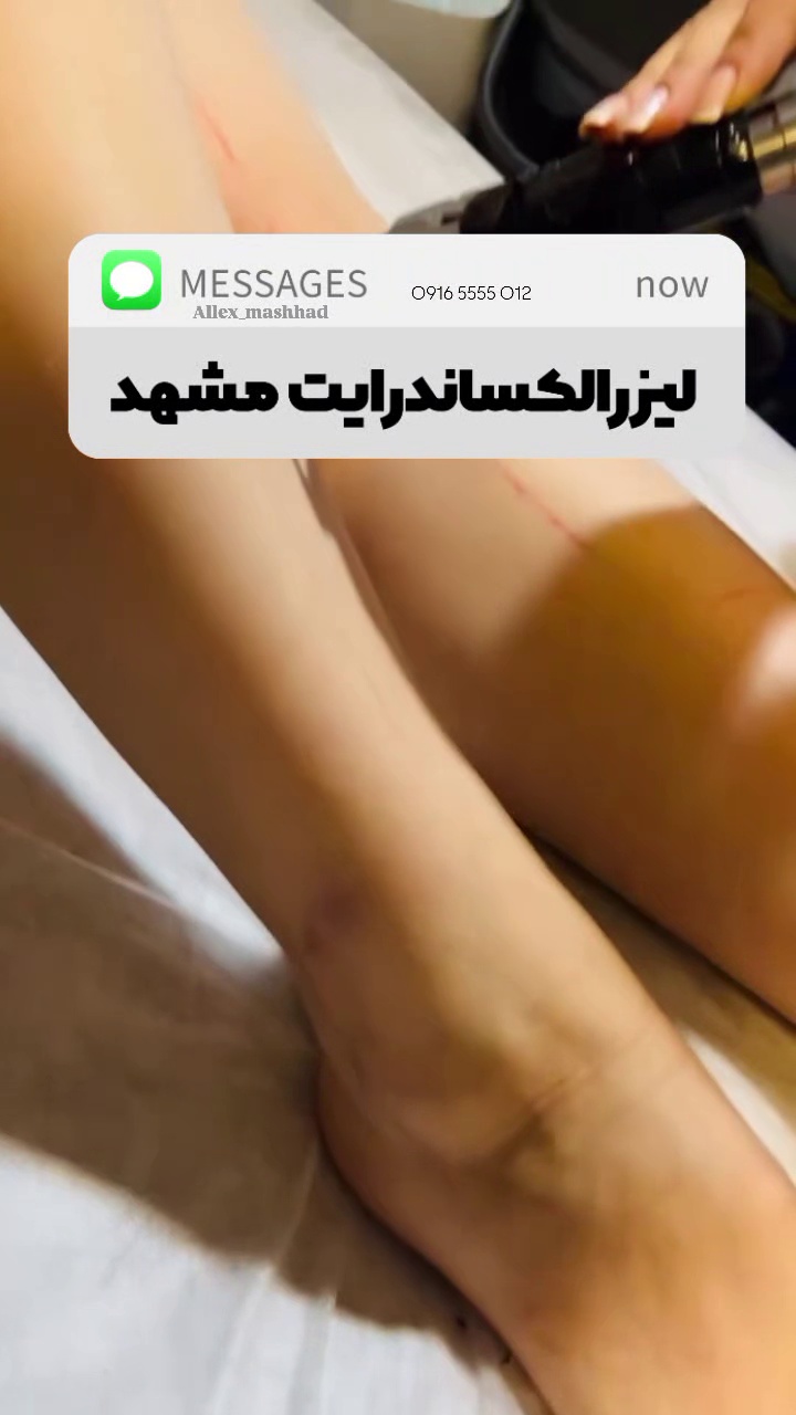 لیزرالکساندرایت دکا مشهد