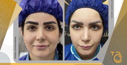 کلینیک کاشت ابرو ابروکمون