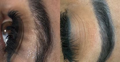 کلینیک ریموو (پاک کردن) تتوو با لیزر رُز