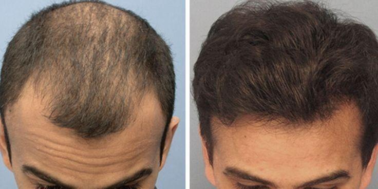 درمان تخصصی ریش و مو