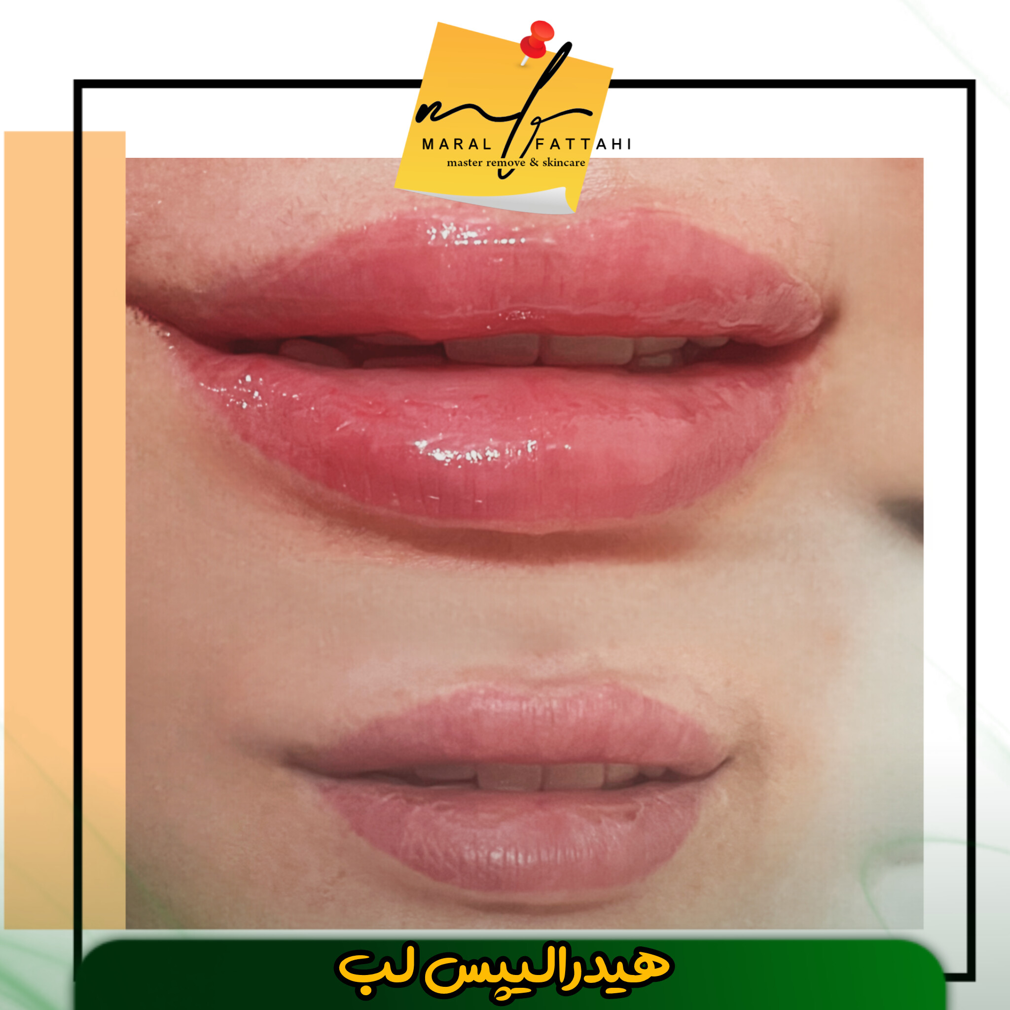 ریموو علمی تتو با اصول پزشکی مارال