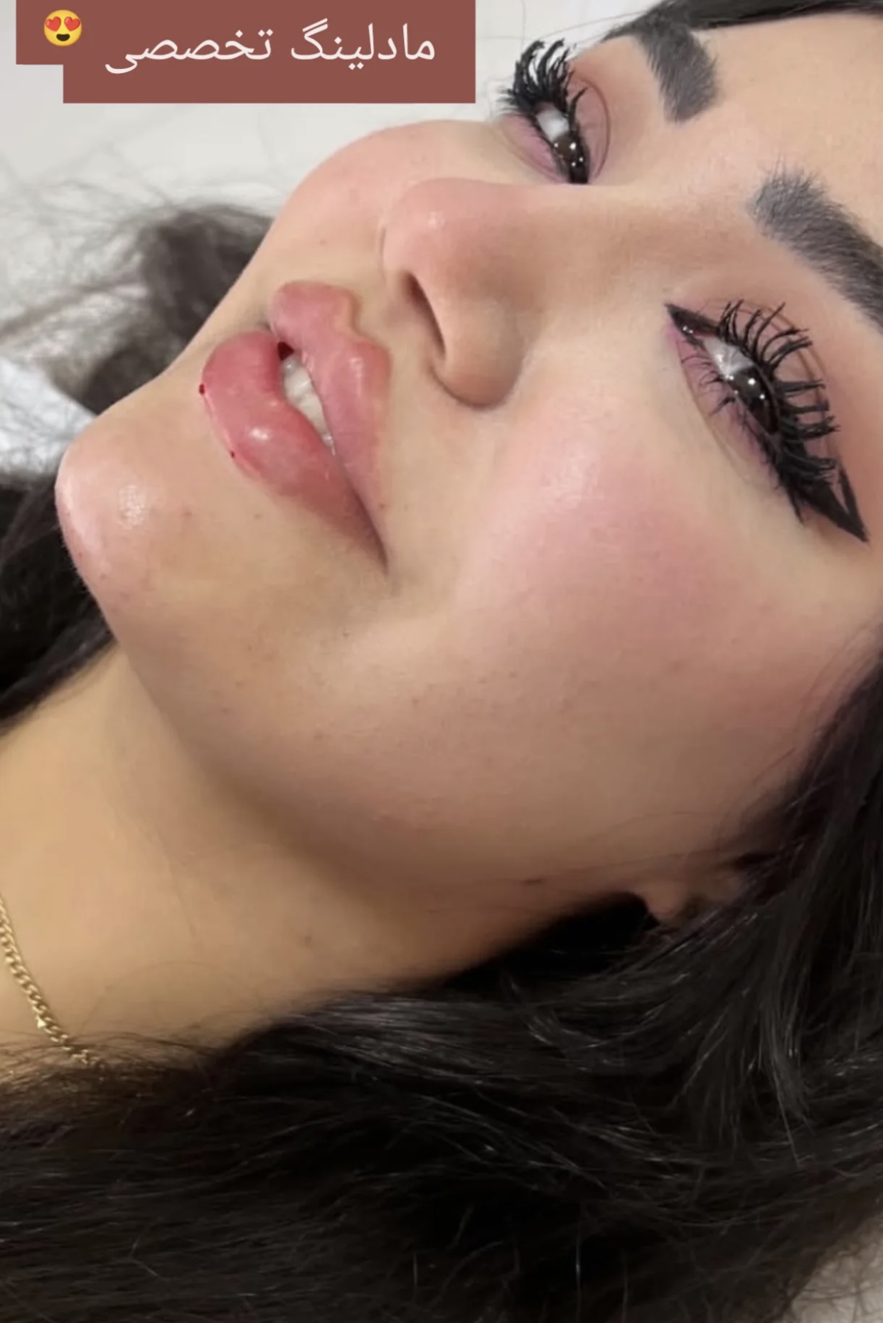 تزریق ژل و بوتاکس مقصودی