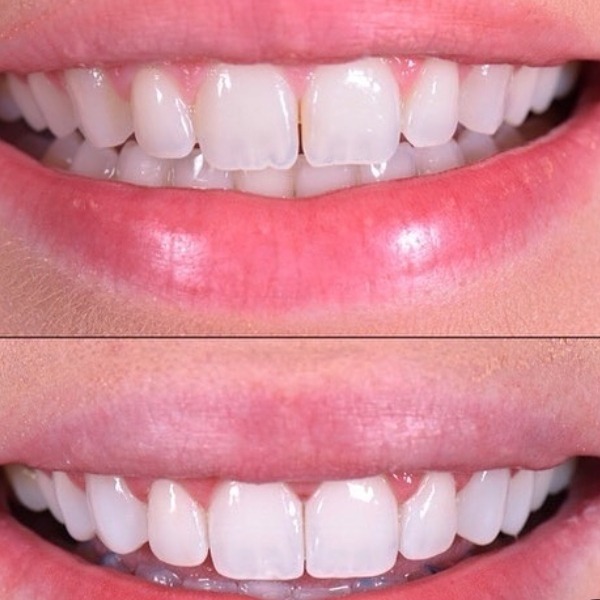 کامپوزیت دندان