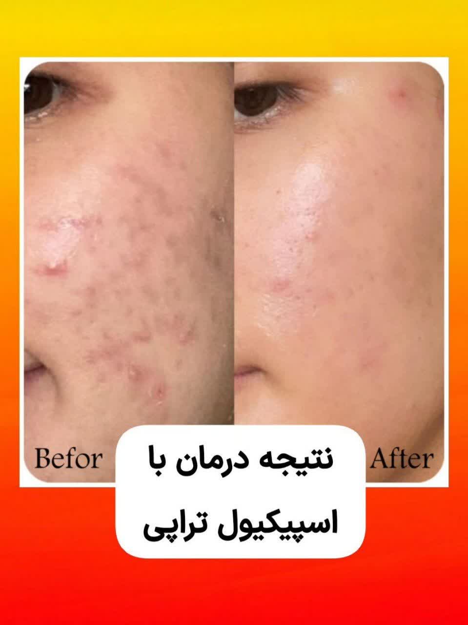 فیشال و پاکسازی پوست کارن