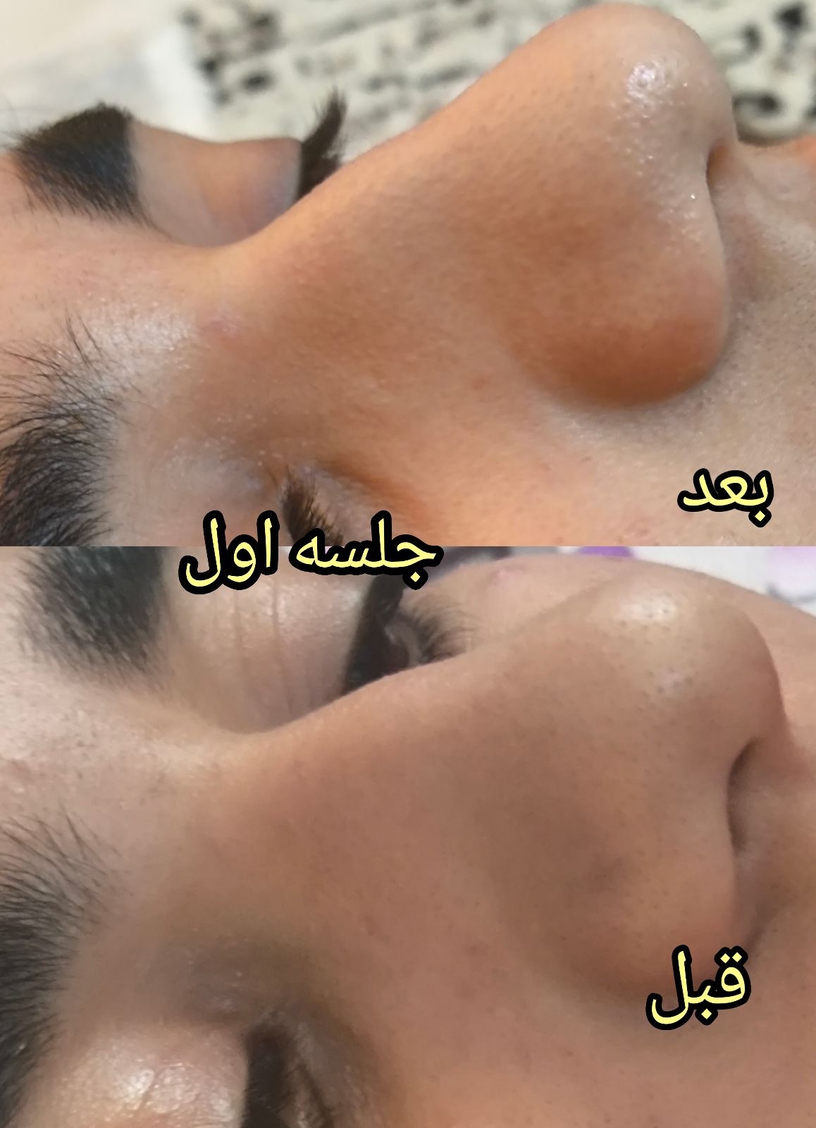 پلاسمای صورت  و چربی سوزی بینی