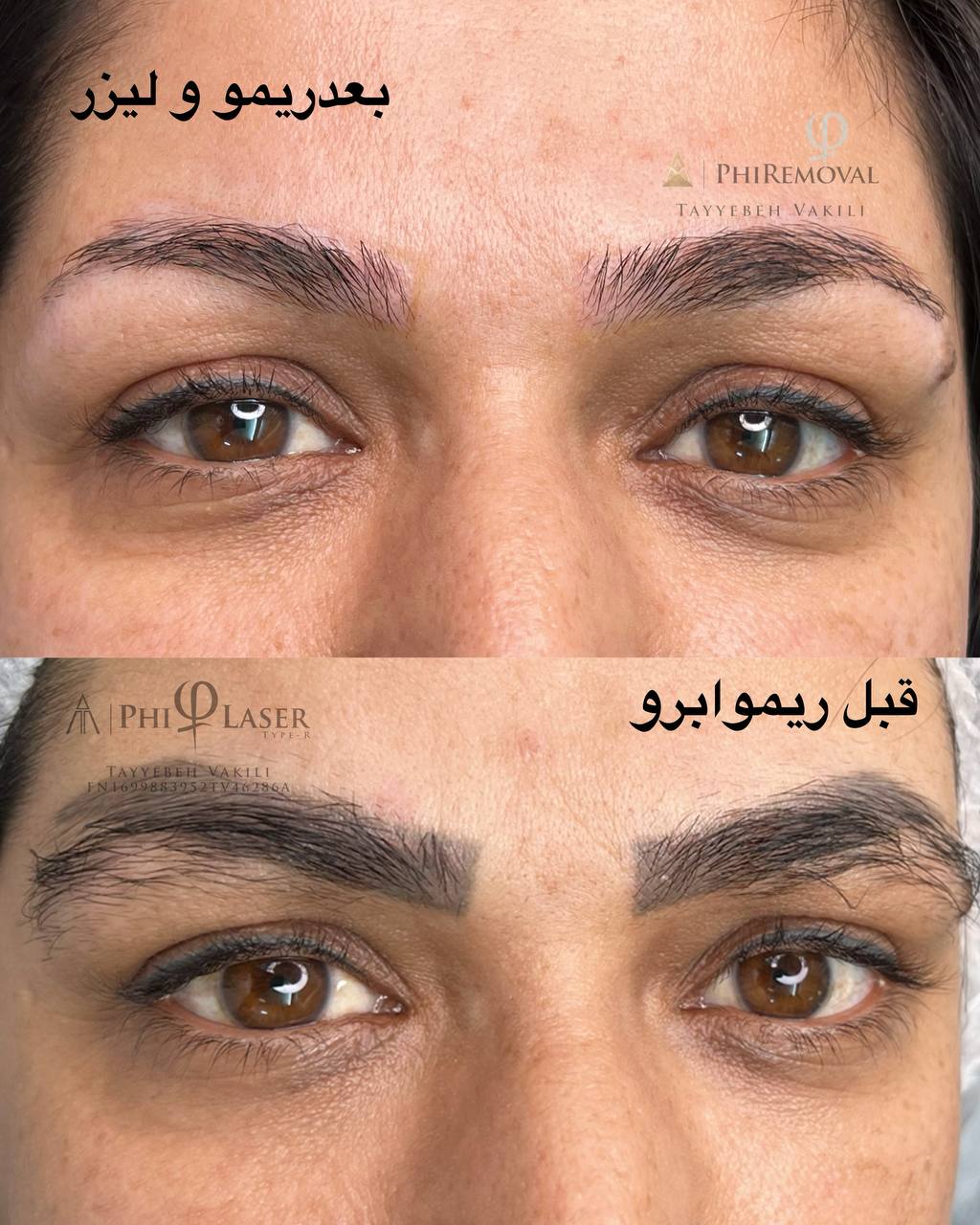کلینیک تخصصی فاطمه وکیلی/ میکروبلیدینگ