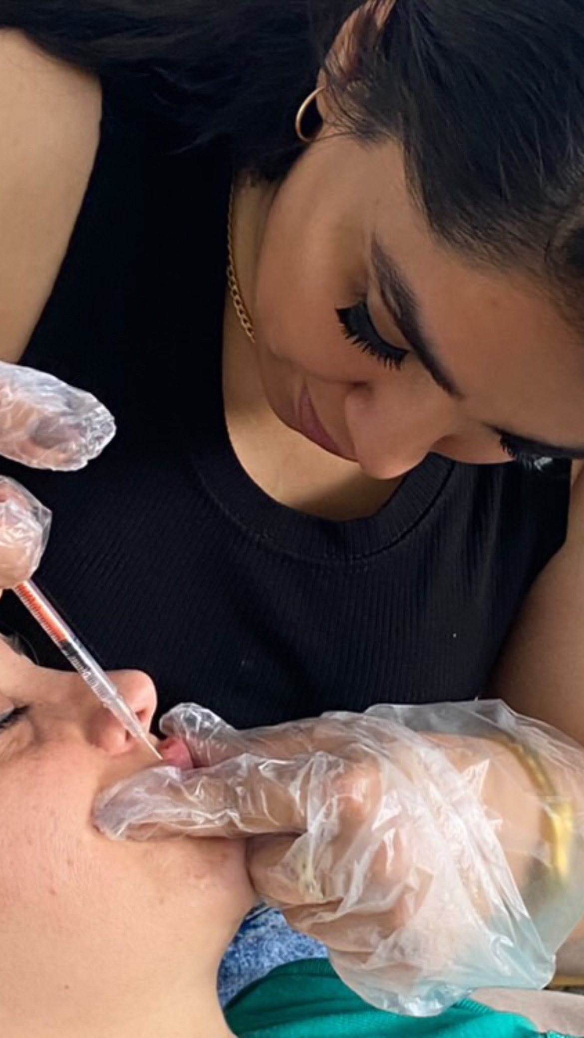 ژل و بوتاکس ابرا