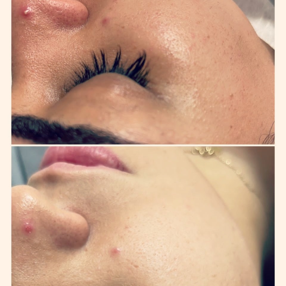 فیشال و پاکسازی پوست لیلو