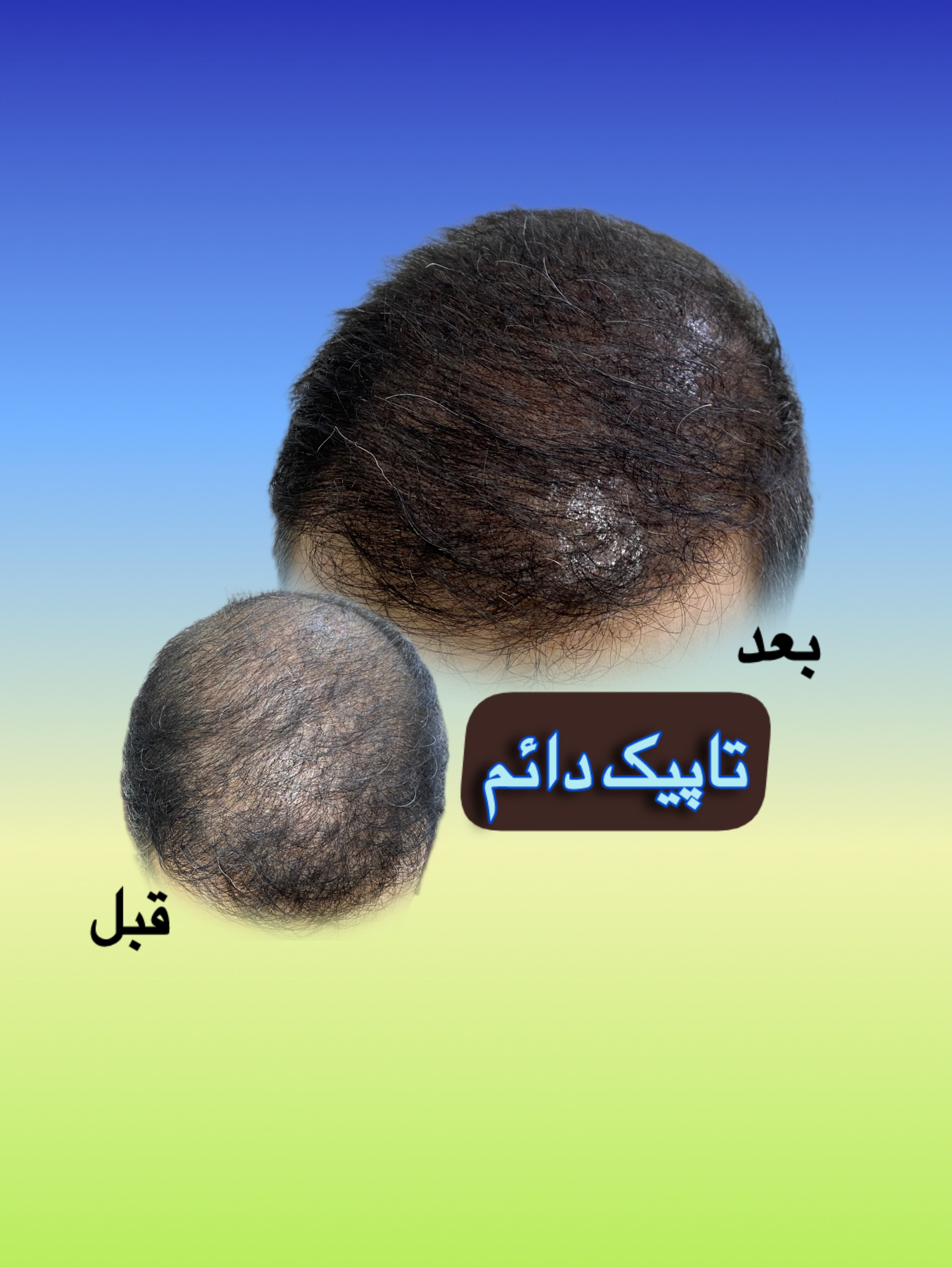 موسسه آموزش و درمان انواع ریزش مو ریشه