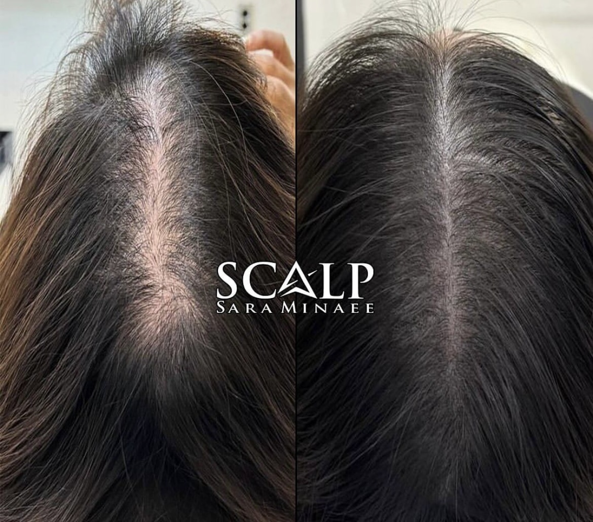 خدمات میکرواسکالپ سر سارا مینایی