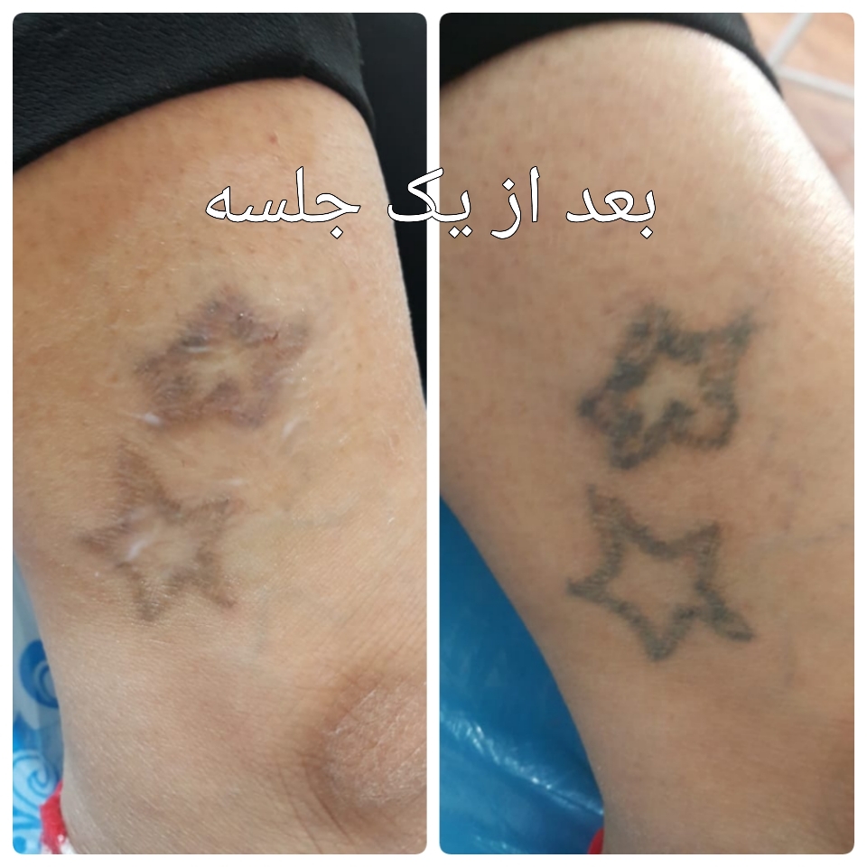 مرکز لیزر نیکی