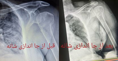 شکسته بندی محمد علی مختار