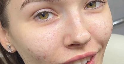 خدمات تخصصی فیشال و پاکسازی پوست حفظی