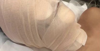 فشیال و پاکسازی و میکرونیدلینگ و مزونیدلینگ