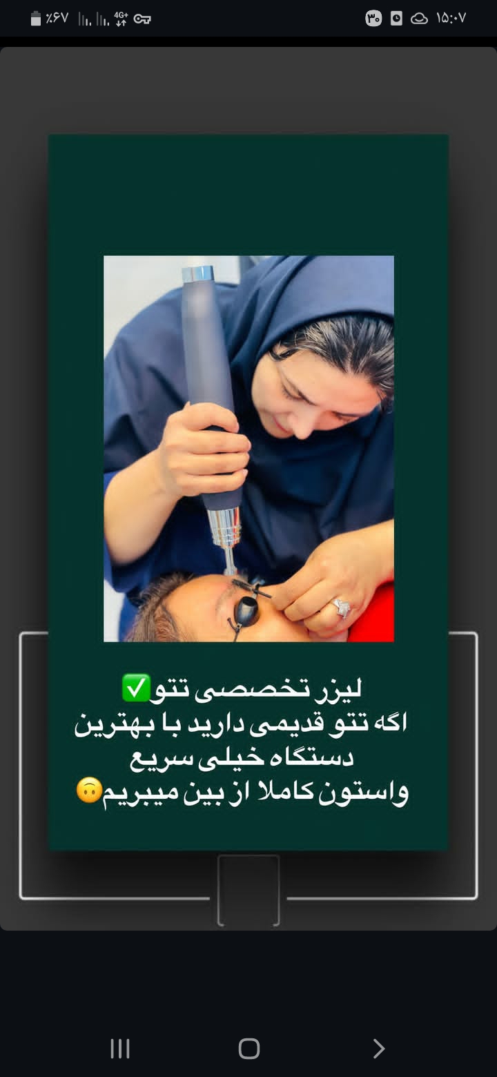 پاک کردن تاتو با لیزر کیوسوئیچ