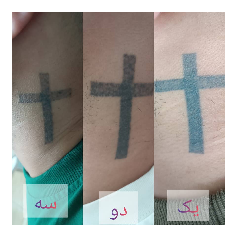 کلینیک آنابل مرکز تخصصی پاک کردن تتو